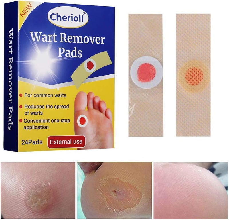 Cherioll Wart Remover Corn Complete Removal Corn Remover Foot Corn Remover Pads Plantar Wart Removal Penetrates and Removes Common and Plantar Warts Callus Stops Wart Regrowth - Image 2