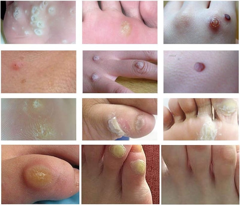 Cherioll Wart Remover Corn Complete Removal Corn Remover Foot Corn Remover Pads Plantar Wart Removal Penetrates and Removes Common and Plantar Warts Callus Stops Wart Regrowth - Image 3