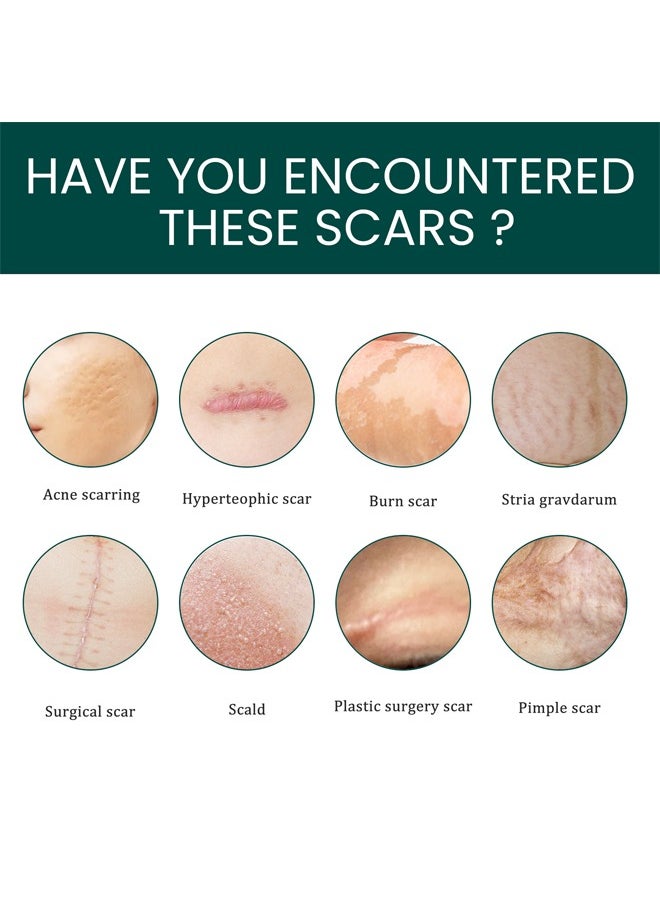 EELHOE - Silicone Scar Sheets (Scar Roll-4*150cm), Silicone Scar Tape, Reusable Silicone Scar Tape, Beauty Patch Scar Patch, Scar Removal Away Strips for Keloid, C-Section, Surgery, Burn, Acne et - Image 1
