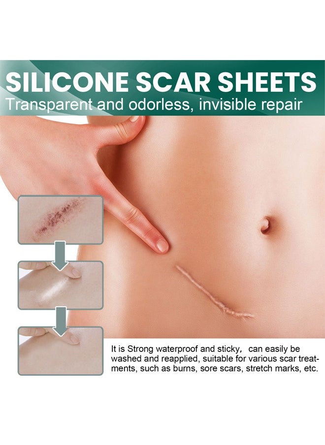 EELHOE - Silicone Scar Sheets (Scar Roll-4*150cm), Silicone Scar Tape, Reusable Silicone Scar Tape, Beauty Patch Scar Patch, Scar Removal Away Strips for Keloid, C-Section, Surgery, Burn, Acne et - Image 1