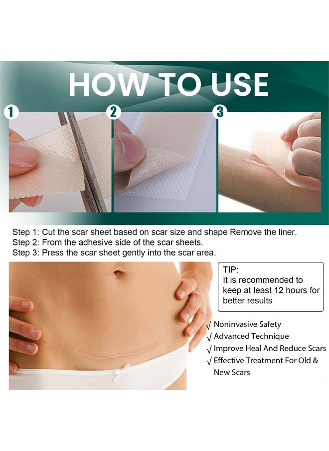 EELHOE - Silicone Scar Sheets (Scar Roll-4*150cm), Silicone Scar Tape, Reusable Silicone Scar Tape, Beauty Patch Scar Patch, Scar Removal Away Strips for Keloid, C-Section, Surgery, Burn, Acne et - Image 1