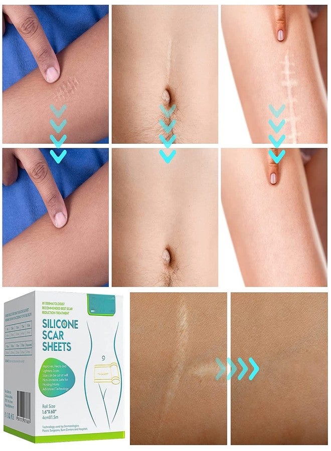 DPISZONE Silicone Scar Sheets, Silicon gel sheets for Scars Transparent Medical Silicone Gel Tape for Scar Removal, Silicone Scar Tape Roll For Hypertrophic Scars and Keloids Caused by Surgery - Image 2