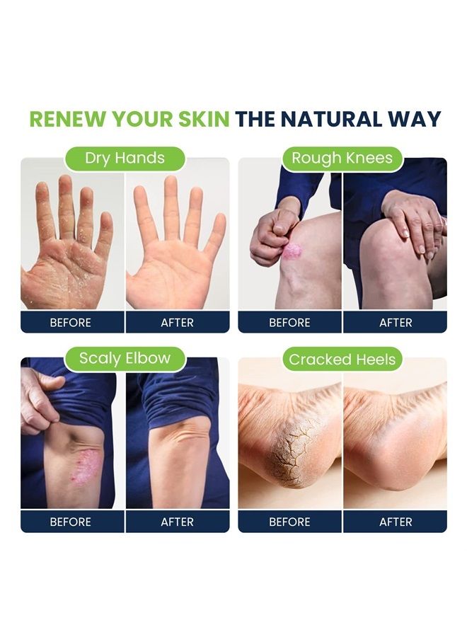 Foot Cure Tea Tree Oil Foot Cream - Moisturizing Athletes Foot Care For Dry Cracked Feet Cream - Heel & Callus Removal, Toenail Treatment, Ringworm Itchiness Relief - Made in USA (Foot Cream, 2 Ounce (Pack of 1 - Image 3