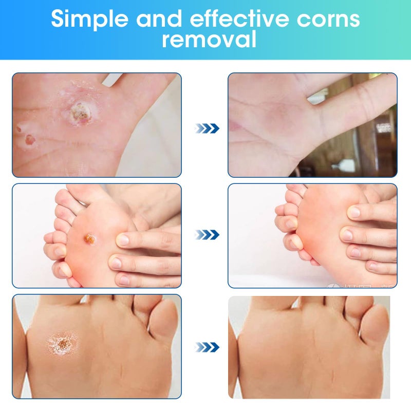 MQUPIN 38 Pcs Corn Removal Pads for Toe,Extra Strength Corn & Callus Remover for Feet & Toes for Adult and Elderly Nurses Hikers and Athletes Men and Women - Image 3