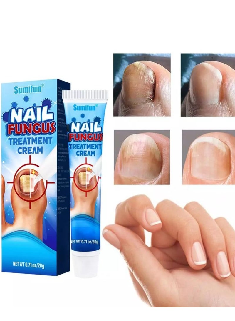 سوميفون كريم علاج فطريات الأظافر يعزز نمو الأظافر ويحسن مظهر الأظافر المتقدمة في السن، عناية مغذية بالأظافر وتخفيف آلام الأظافر، كريم إصلاح الأظافر 20 جرام - Image 1