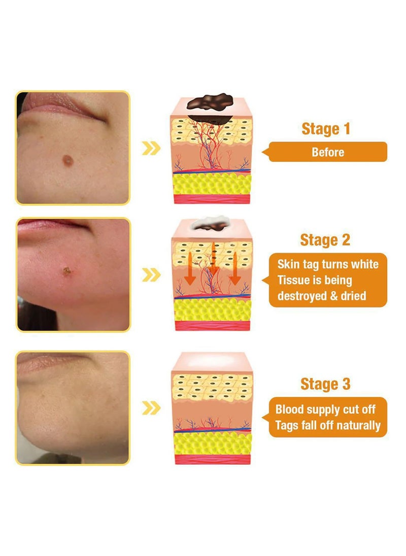 SYOSI Bee Venom Wart and Tag Removal Cream, Gentle Skin Treatment for All Skin Types, Easy to Apply and Non-Irritating, Effective Bee Venom Solution for Warts, Skin Tags, and Blemishes, Safe Daily Use  - Image 5