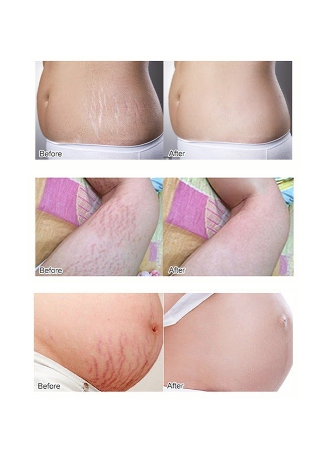 OEDO Rose Remove Stretch Marks Cream， Natural Plant Essence Formula Maternity Skin Treatmentpregnancy Scarsrepair Cream 40g - Image 5