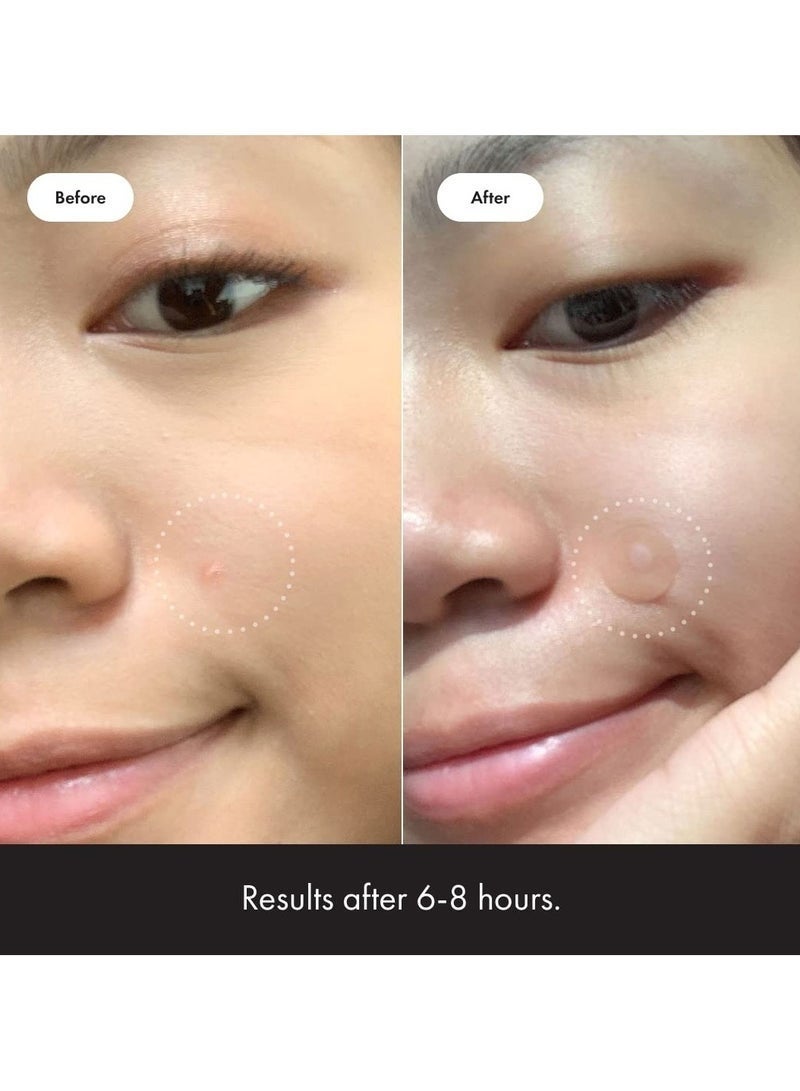 Hero (72 Count)Powerful Acne Pimple Patch – Hydrocolloid Spot Treatment for Face and Skin, Invisible Waterproof Acne Patch for Overnight Healing - Image 5
