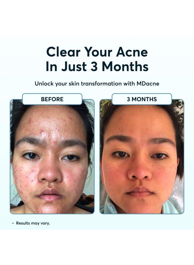 MDacne مجموعة علاج حب الشباب بخطوات 3 مع كريم بنزويل بيروكسايد 2.5% وغسول حمض الساليسيليك ومرطب النياسيناميد مجموعة طبية نباتية لحب الشباب للبالغين والمراهقين مجموعة حب الشباب لمدة 30 يومًا - Image 4