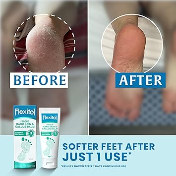 Flexitol Rescue Hard Skin and Callus Balm Foot Cream for Visible Results in 3 Days Exfoliates Dry Hard Feet Clinically Proven to Soften Feet 22 Percent Urea Suitable for Diabetics 56g - Image 2