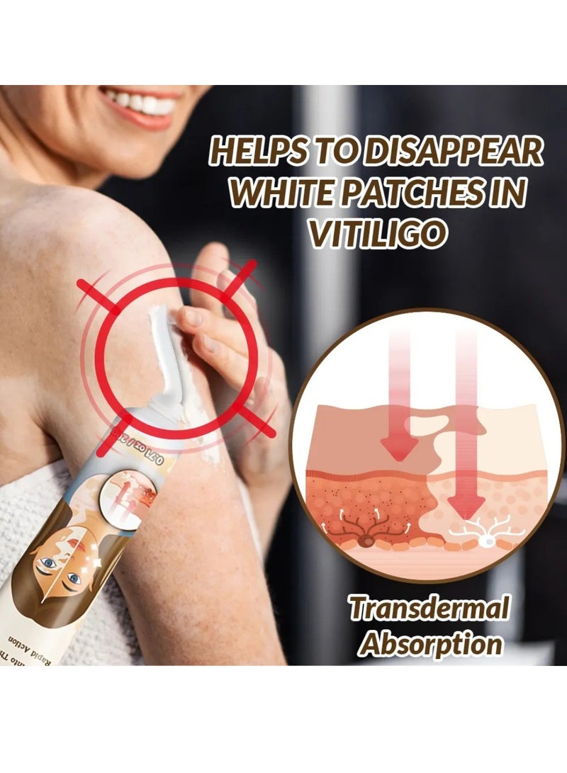 Sumifun كريم إزالة البهاق للوجه والجسم لتحسين لون البشرة وتقليل البقع البيضاء كريم علاج البهاق يقلل البقع البيضاء على البشرة يحسن لون البشرة كريم البهاق 20 جرام - Image 5