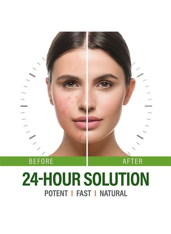 MOOYAM - Anti Acne Face Serum, Neem Leaf Oil, Tea Tree Oil, Caviar Lime Fruit Extract with Dextran & Tripeptice-1 and Lemon Anti-Acne Face, Anti-wrinkle firming, Whitening Facial Repair Serum 50ml, for Acne Prone Skin Type - Image 1