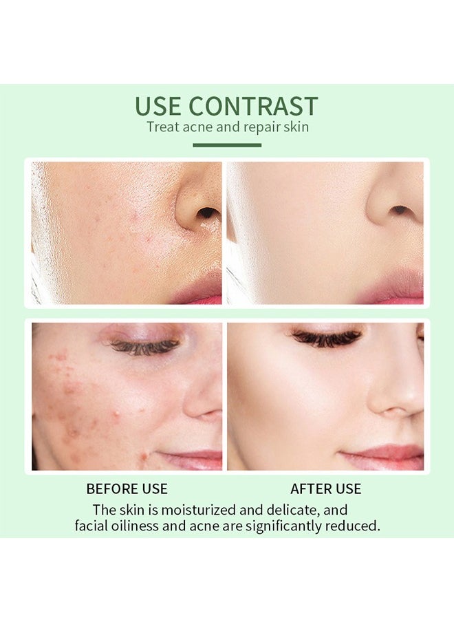 MOOYAM - Anti Acne Face Serum, Neem Leaf Oil, Tea Tree Oil, Caviar Lime Fruit Extract with Dextran & Tripeptice-1 and Lemon Anti-Acne Face, Anti-wrinkle firming, Whitening Facial Repair Serum 50ml, for Acne Prone Skin Type - Image 1