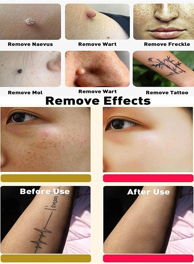 Handheld Picosecond/Skin Tattoo/Black Spot Removal Pen/Beauty Instrument (Blue Light) - Image 5