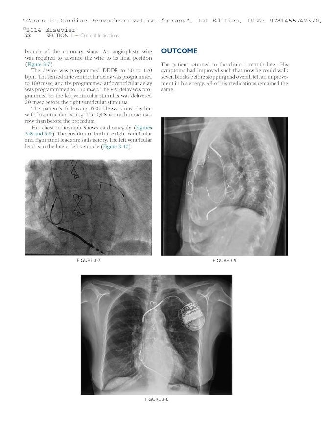 Cases in Cardiac Resynchronization Therapy: Expert Consult - Online and Print  - Image 5