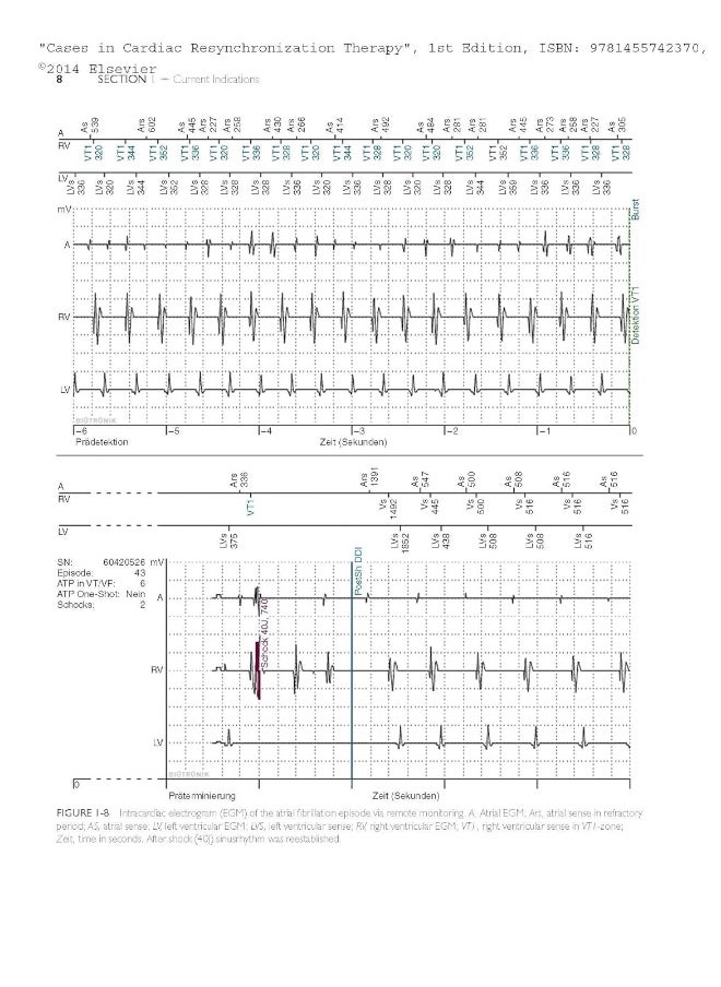 Cases in Cardiac Resynchronization Therapy: Expert Consult - Online and Print  - Image 4