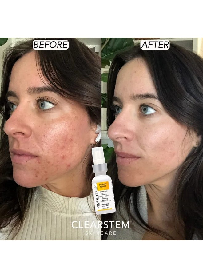 CLEARstem Clearity The Blackhead Dissolver Mandelic Acid Serum Vitamin C Turmeric Collagen Boost All Skin Types Facial Skin Care Products Vegan Gluten Free Cruelty Free 1 Fl Oz / 29Ml  - Image 4