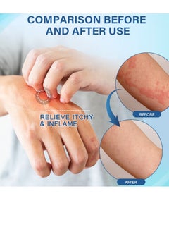 Sumifun Allergy  Care Cream For Skin Allegry Skin Itching Skin Redness And Swelling 20g  - Image 2