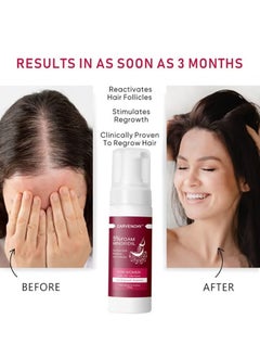 CARVENCHY 5% Minoxidil Foam for Hair Thinning and Hair Loss, Revivies And Restores Hair Follicles,Hair Growth Treatment for Women's Thicker and Fuller Hair,Easy-to-use Foam 2pcs  - Image 4