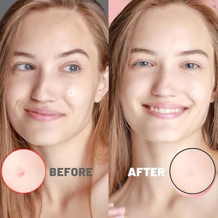 TOLEVITA Hydrocolloid Acne Patches for Face | Blemish and Zit Covering Patches for All Skin Types | Pimple Spot Stickers for Clear Skin | Waterproof, Invisible Patches for Day & Night Use - 36 Pcs - Image 4
