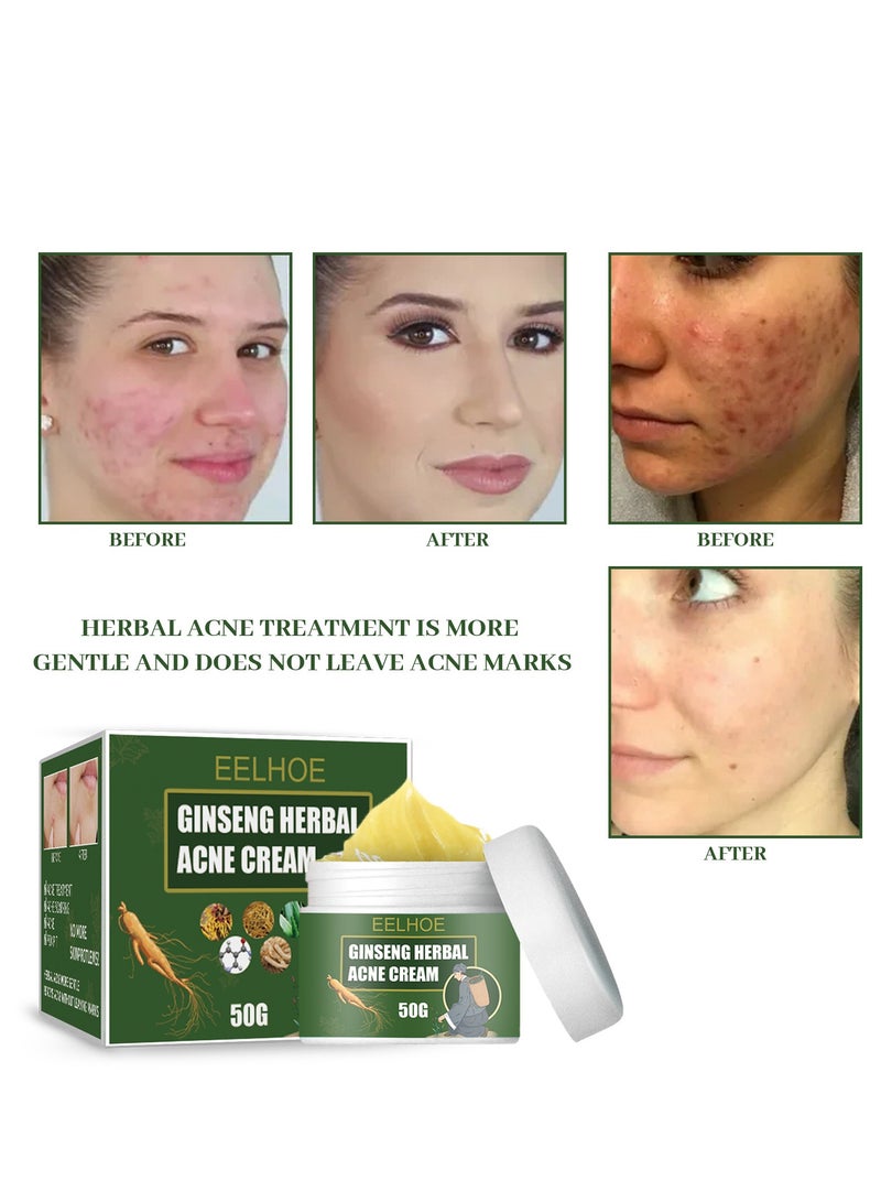 إيلهو كريم علاج حب الشباب ، كريم حب الشباب في الوجه ، كريم حب الشباب الموضعي وأدوية جل حب الشباب ، كريم حب الشباب البنزويل بيروكسيد 5٪ مع زيت شجرة الشاي لحب الشباب في الوجه 50 جم - Image 3