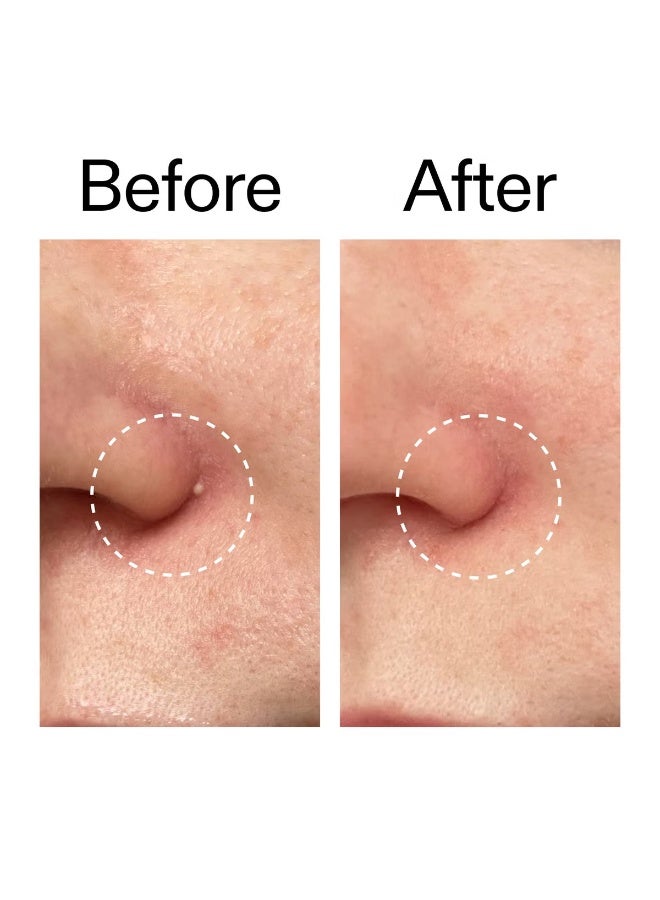 Hydrocolloid Invisible Pimple Patches 22 patches - Image 2