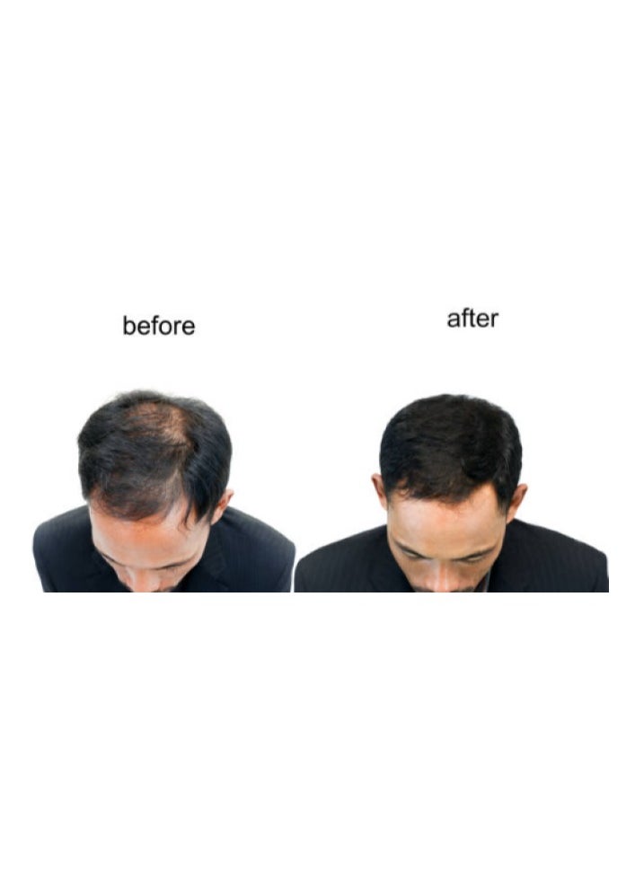 Dar Al Dawa Pack Of 3 Hairgrow 5% Minoxidil 3 Months Supply, 50Ml Each  - Image 3