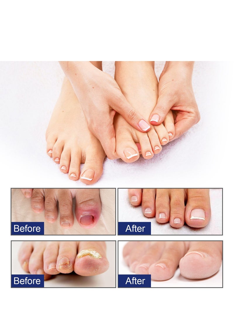Toenail ingrown relief solution treats ingrown toenails and relieves toenail pain