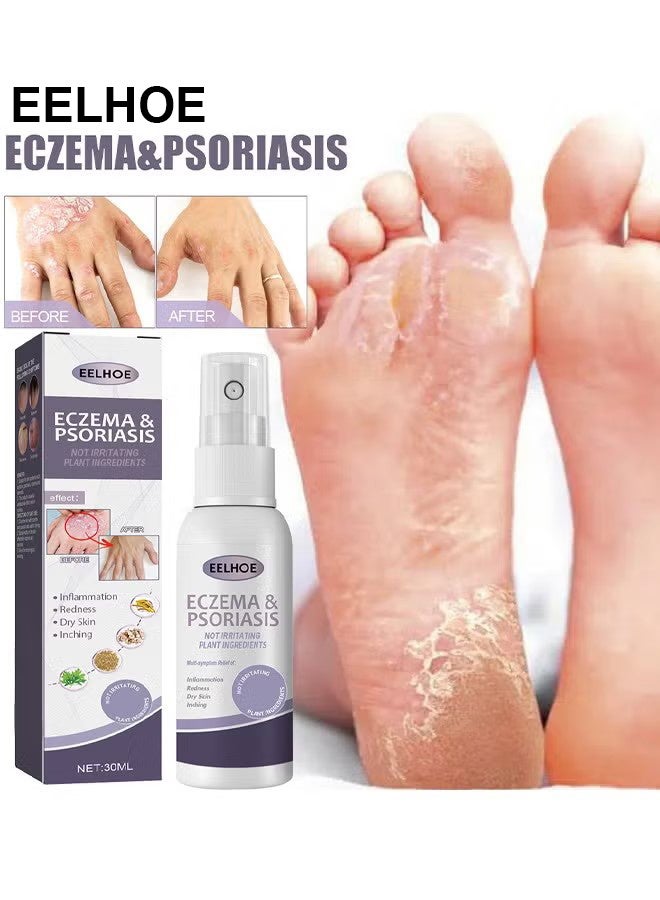 إيلهو الاكزيما والصدفية رذاذ متناهية الصغر 30ml ، إصلاح الجلد من ناحية القدم موس ، تخفيف الحكة ، العناية بالبشرة وتنظيف رذاذ ، مضاد للجراثيم آمنة دون تهيج - Image 2