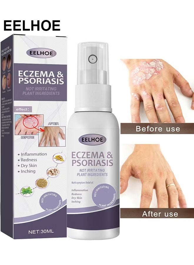 إيلهو الاكزيما والصدفية رذاذ متناهية الصغر 30ml ، إصلاح الجلد من ناحية القدم موس ، تخفيف الحكة ، العناية بالبشرة وتنظيف رذاذ ، مضاد للجراثيم آمنة دون تهيج - Image 1