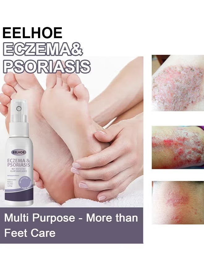 إيلهو الاكزيما والصدفية رذاذ متناهية الصغر 30ml ، إصلاح الجلد من ناحية القدم موس ، تخفيف الحكة ، العناية بالبشرة وتنظيف رذاذ ، مضاد للجراثيم آمنة دون تهيج - Image 5