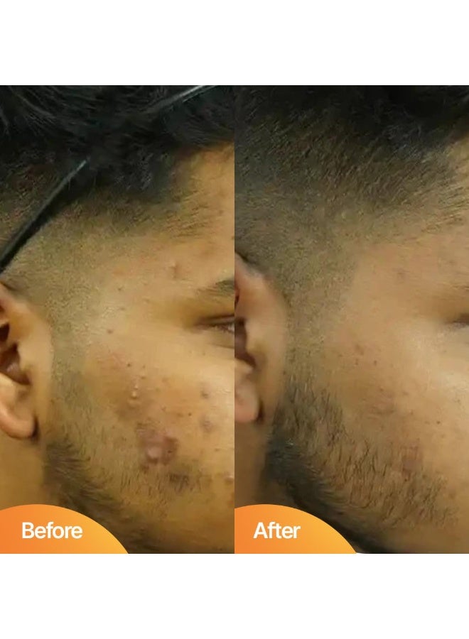 Beardhood Acne Pimple Patch | 72 Patches | Pimple Patches for Face Salicylic Acid, Hydrocolloid Waterproof Patch for Active Surface Acne, Absorbs Pimple Overnight, Reduces Excess Oil, For All Skins - Image 2