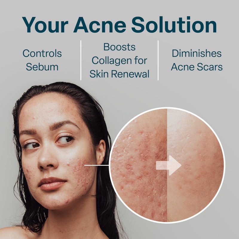 QRxLabs Salicylic & Glycolic Acid Pads (2% Salicylic & 10% Glycolic) - Acne Pads for Face & Bacne with Vitamins B5, C & E, Calendula & Green Tea - Face Exfoliator - 50 Count Jar - Image 4