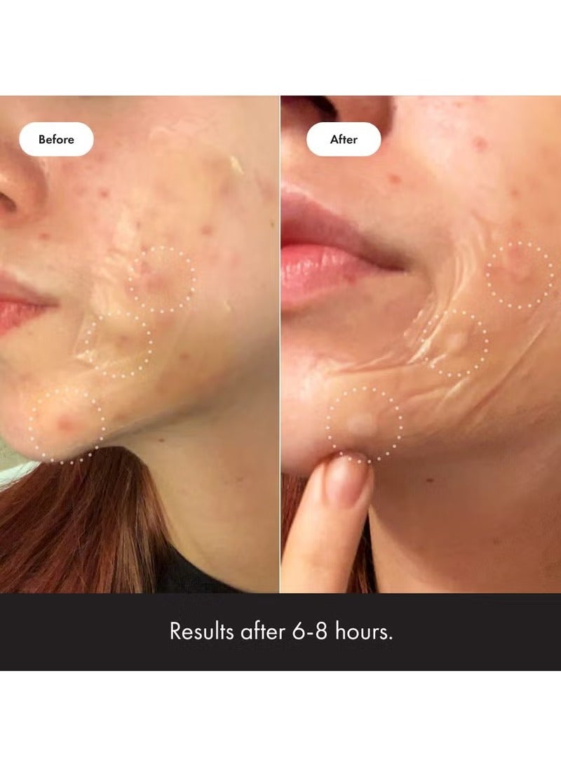 Mighty Patch Surface from Hero Cosmetics - Hydrocolloid Spot Patch for Body, Cheek, Forehead, and Chin, Vegan-friendly (10 Count) - Image 5