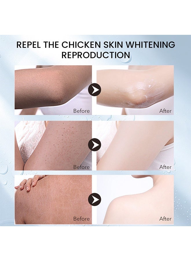 Sumifun Keratosis Pilaris Repair Cream 30g, Vitamin E Cream, Chicken Skin Cream Urea Exfoliates Lumps - Image 4