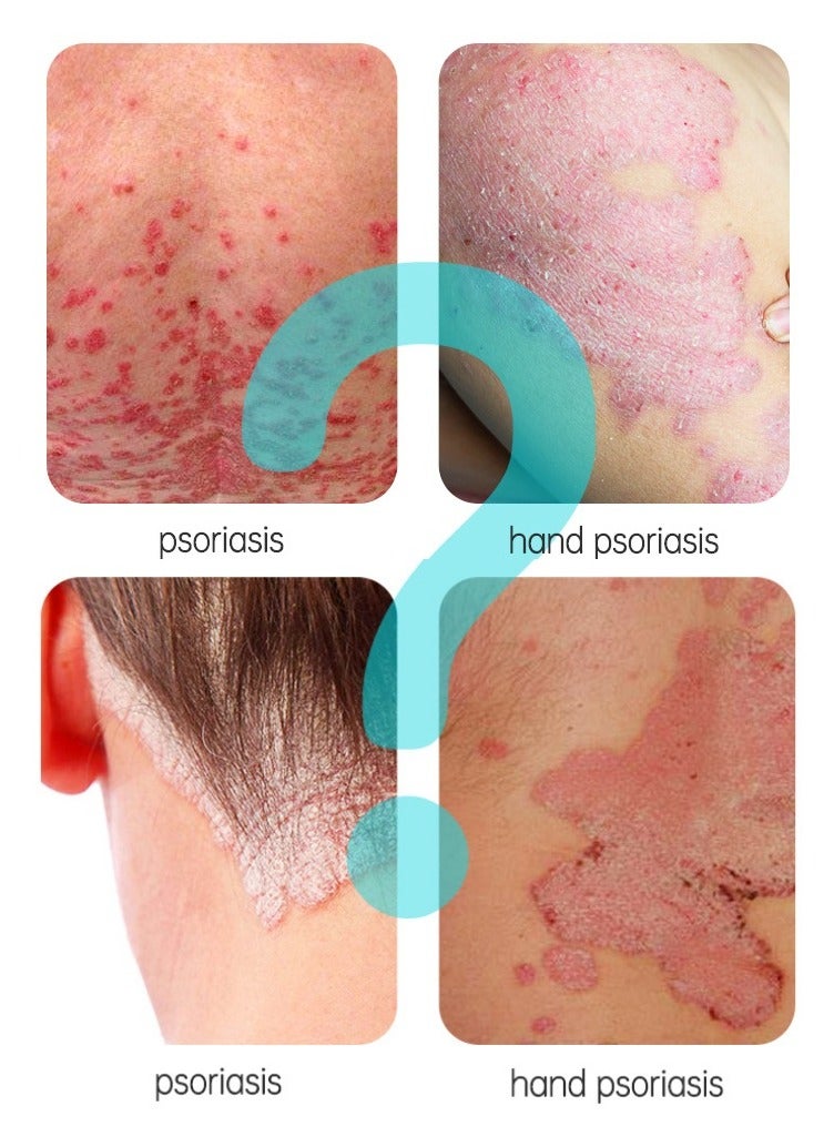 جوي برتي Psoriasis Relief Cream , Anti-Bacterial Moisturizer for Scaly Skin u0026 Redness – Natural Herbal Cream for Eczema, Dermatitis, Psoriasis, and Vitiligo – Unisex (20g) - Image 2