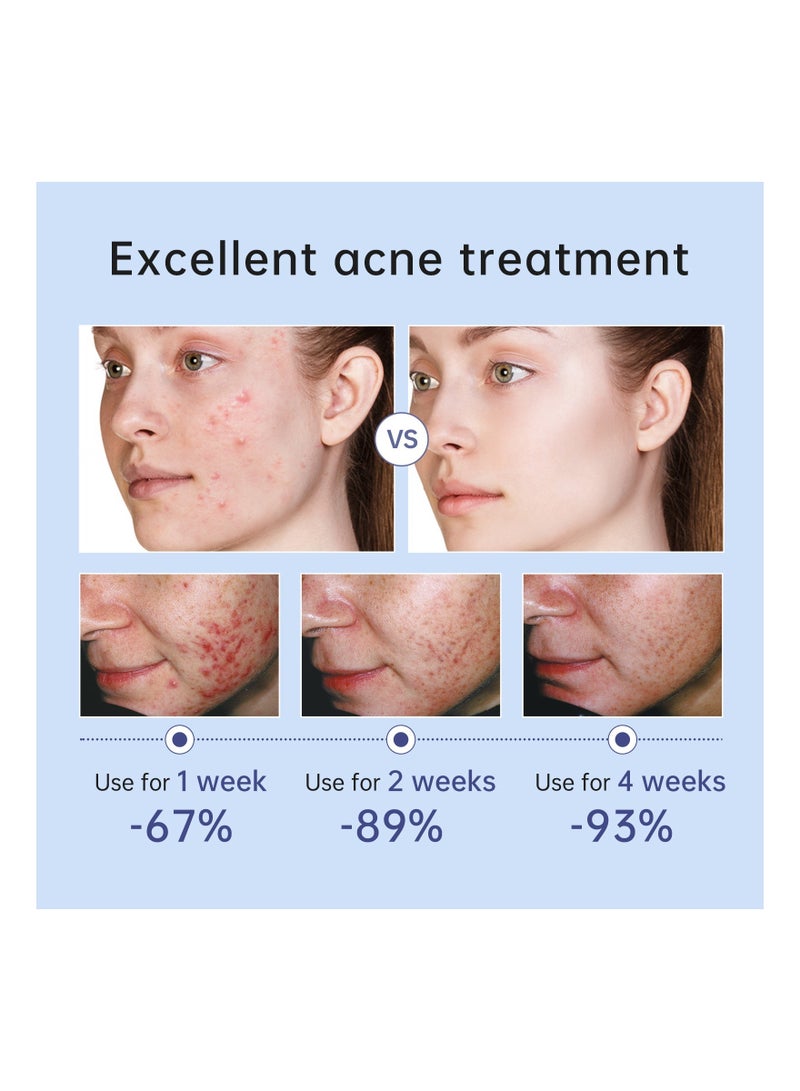 AuQuest Acne Remoyal Gure Gel, Herbal Acne Treatment Cream, Smooth And Gentle Pimple Spot Removal, Safe And Effective Skin Care Beauty Cream For Teen Womens, (1pc) - Image 5