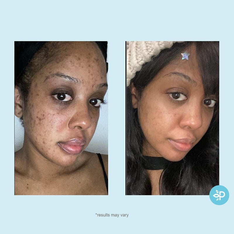 PERFECT IMAGE Salicylic 10% Gel Peel, Breakout and Pore Minimizer and Cleanser, 15-30 Full Facial Chemical Peels, 1 fl oz. e, 30 mL - Perfect Image - Image 4