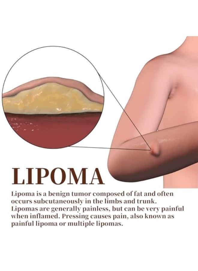 EELHOE Lipoma Soothing Cream, Lipoma Removal Cream, Instant Lipoma Removal Cream, LumpFree Lipoma Removal Cream, Herbal Lipoma Removal Cream, Natural Vegetable Cream for Removing Lipoma Clumps, 20 g - Image 5