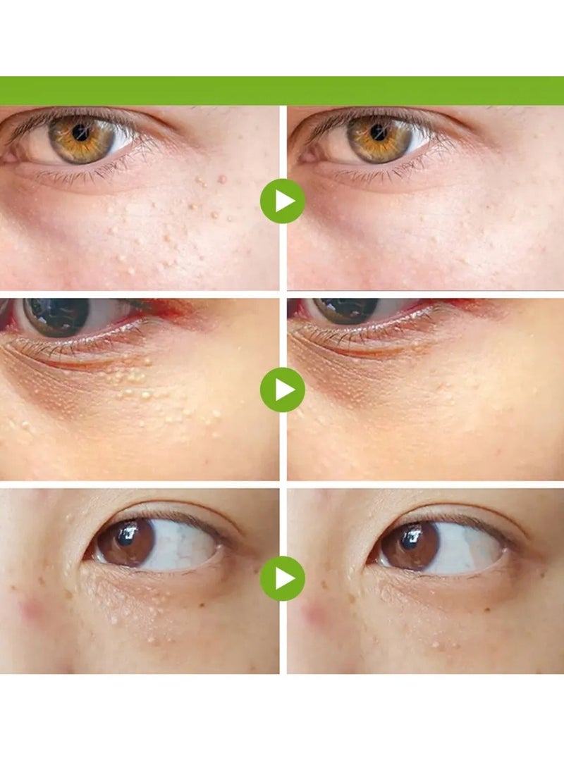 Sumifun - Vitamin E Fat Granule Cream Firms and Repairs Skin Around Eyes Eye Health Support Effective Removal of Fat Particles Granules Specific Eye Care Under Eye Care Cream 20g - Image 1