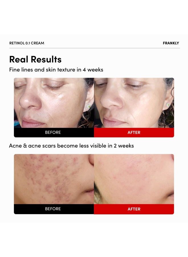 FRANKLY Retinol 0.3% Cream, 0.7 fl oz - Intensive Retinol | Night Cream | Retinol, Ceramides & Natural Ginseng | Anti-aging, Wrinkles Care, Reduces Congestion and hyperpigmentation | Korean Skin Care - Image 2