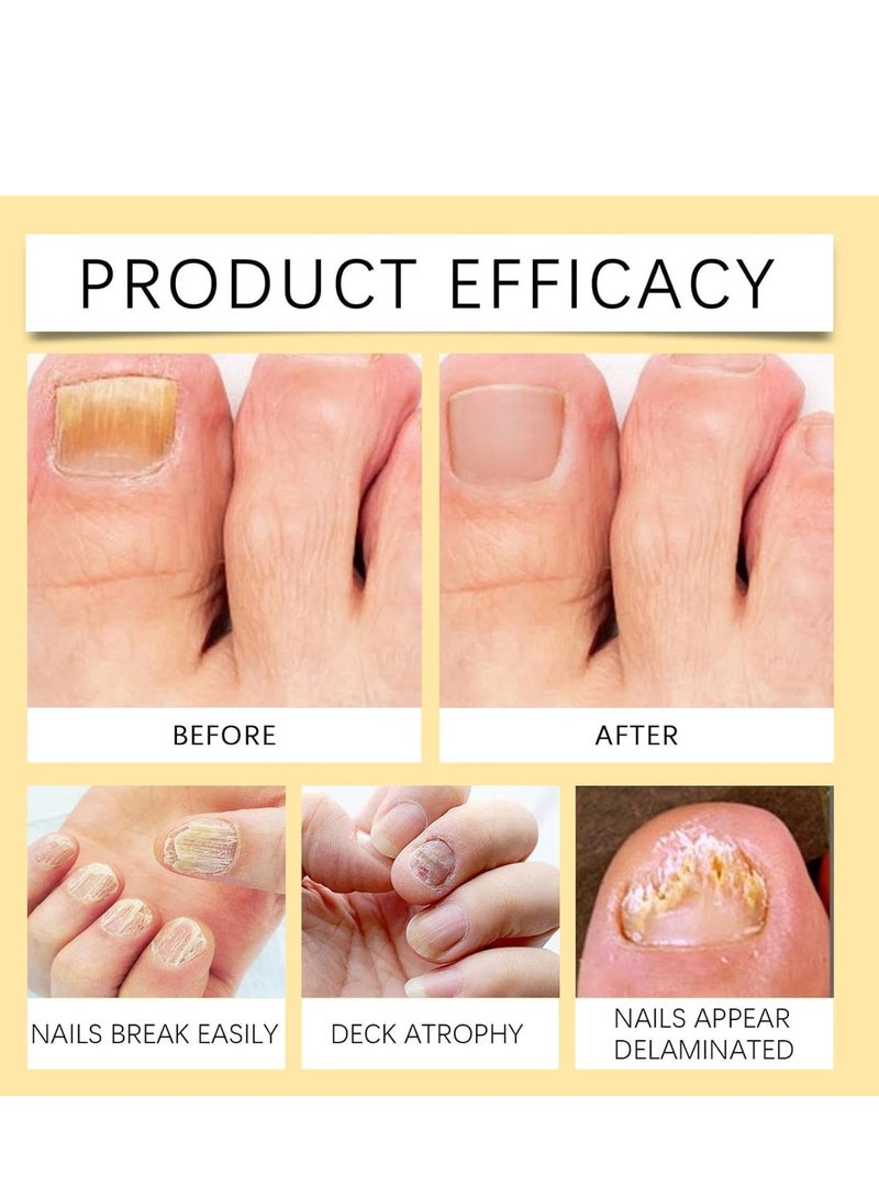 ximonth Bee Venom Nail Treatment Extra Strength, Anti-Fungus Care Spray for Ingrown and Discolored Nails, Safe & Effective for Nail Health and Growth (100ml) - Image 3