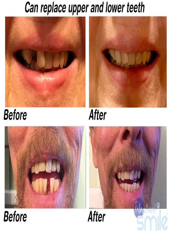 إنستانت سمايل طقم إصلاح الأسنان المؤقت Instant Smile MULTISHADE الحاصل على براءة اختراع. حلٌّ واقعي المظهر للأسنان المفقودة أو المكسورة. - Image 3