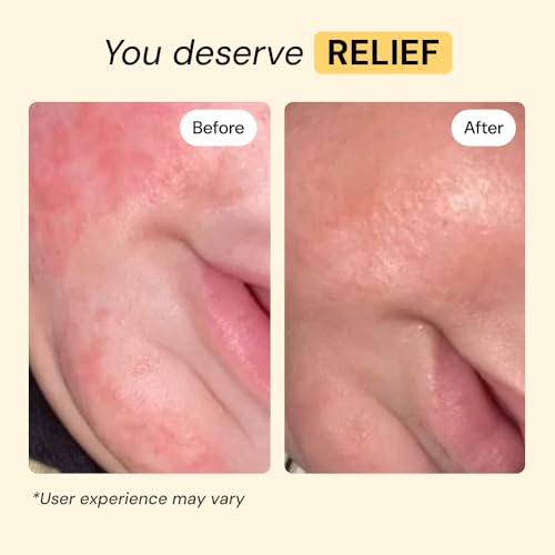 MyMagicHealer Universal Flare Care | Essential Oil Free | Baby Dermatitis, Diaper Rash, Eczema, Psoriasis, Impetigo | Wound Care | Multi-purpose Solution for Sensitive Skin w/Propolis & Egg Yolk 4 oz - Image 3