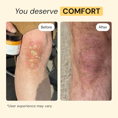 MyMagicHealer Universal Flare Care | Essential Oil Free | Baby Dermatitis, Diaper Rash, Eczema, Psoriasis, Impetigo | Wound Care | Multi-purpose Solution for Sensitive Skin w/Propolis & Egg Yolk 4 oz - Image 4