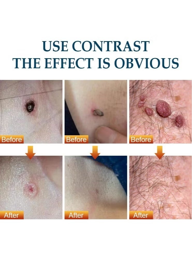 كاني إتش بي كريم مزيل للثآليل – علاج فعال للثآليل الأخمصية والتناسلية ومسامير القدم، 20غ - Image 5