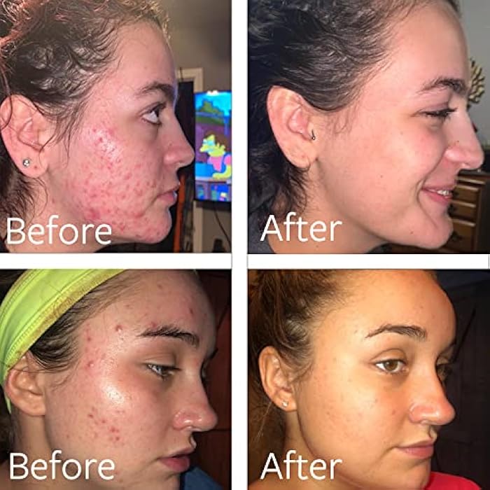 Dr Song غسول دكتور سونغ بيروكسيد البنزيل 10% لعلاج حب الشباب: غسول وجه وحب الشباب للجسم (8 أونصة سائلة (عبوة من 1)) - Image 2