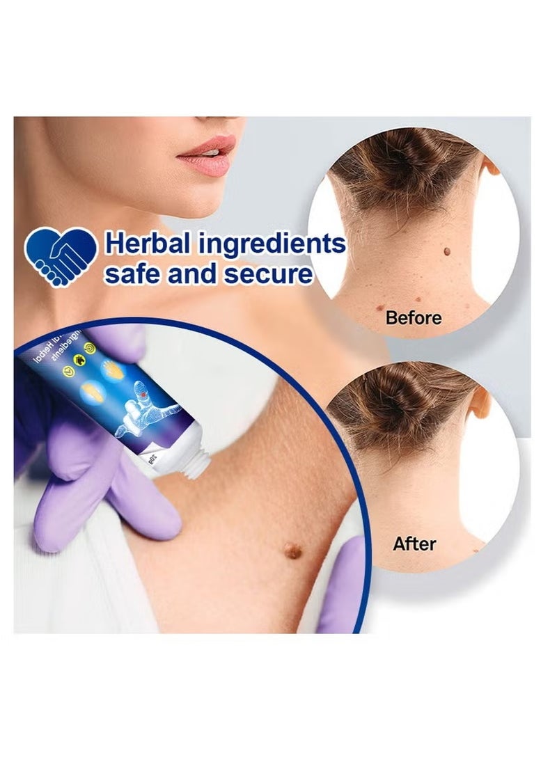 سوميفون مرهم لإزالة الثآليل، ميستاحا 20 جرام - مكونات طبيعية لعلاج الثآليل بشكل آمن، حب الشباب، الشامات، وتقليل الندوب - Image 2