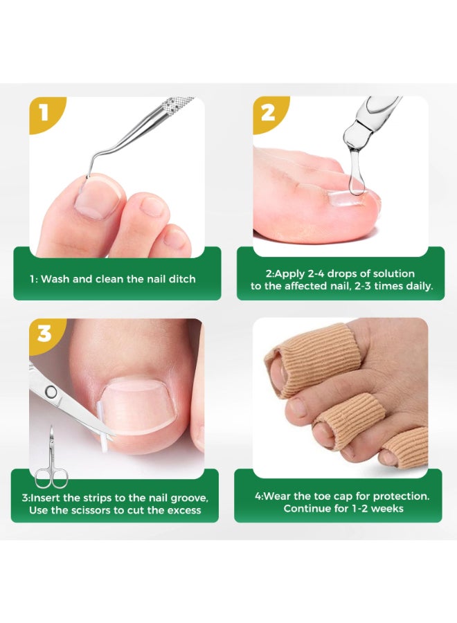 GJNL Ingrown Toenail Kit Ingrown Toenail Drops Ingrown Toenail Set 60 Pcs Toenail Straightener Strips Toenail Lifter Small Scissors - Image 4