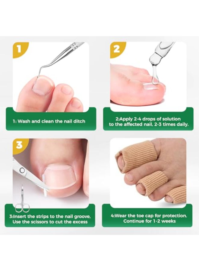 GJNL Ingrown Toenail Kit Ingrown Toenail Drops Ingrown Toenail Set 60 Pcs Toenail Straightener Strips Toenail Lifter Small Scissors - Image 3